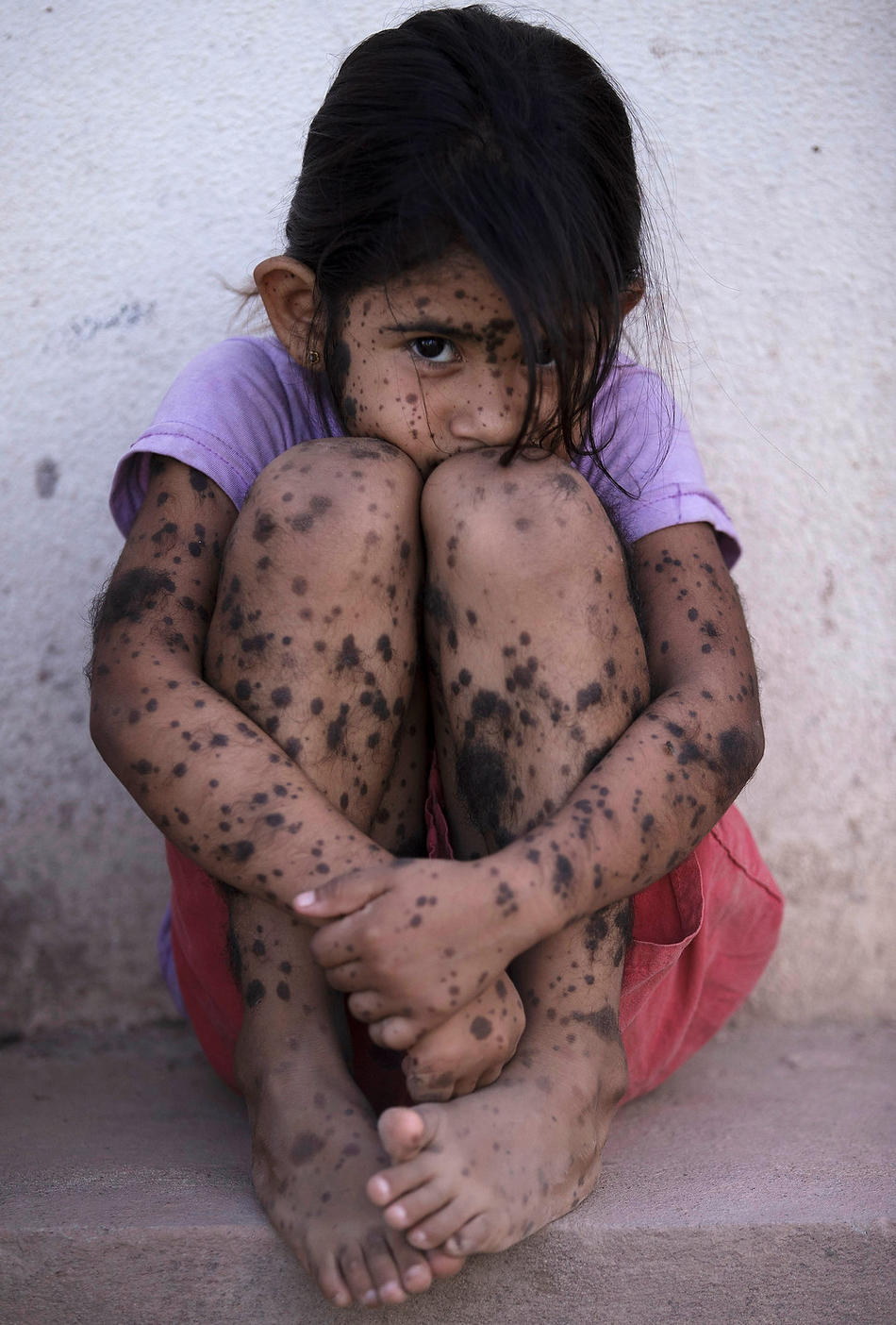 In this April 1, 2013 photo, Aixa Cano, 5, who has hairy moles all over her body that doctors can’t explain, sits on a stoop outside her home in Avia Terai, in Chaco province, Argentina. Although it’s nearly impossible to prove, doctors say Aixa’s birth defect may be linked to agrochemicals. In Chaco, children are four times more likely to be born with devastating birth defects since biotechnology dramatically expanded farming in Argentina. Chemicals routinely contaminate homes, classrooms and drinking water. (AP Photo/Natacha Pisarenko)
